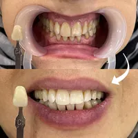 تخفیف ویژه جرمگیری و بلیچینگ (سفید کردن دندان)|خدمات آرایشگری و زیبایی|تهران, امیریه|دیوار