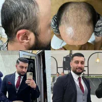 کاشت مو و ابرو با بروز ترین متد کاشت (تبریز)|خدمات آرایشگری و زیبایی|زنجان, |دیوار