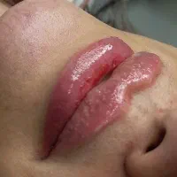تزریق ژل لب و بوتاکس(پک 10cc)،جوانسازی و فیشال|خدمات آرایشگری و زیبایی|تهران, مهران (سیدخندان)|دیوار