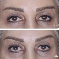 پی آرپی با کیت آمریکایی ۵۵۰ بوتاکس ۵۹۰ فیلر۶۵۰
