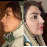 بوتاکس فیلر پی آر پی مزوتراپی زگیل تناسلی|خدمات آرایشگری و زیبایی|تبریز, |دیوار