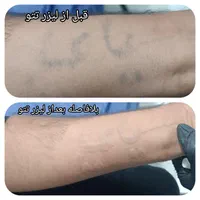 تخفیف لیزر موی بدن باستگاه ۲۰۲۴ امریکایی|خدمات آرایشگری و زیبایی|یاسوج, |دیوار