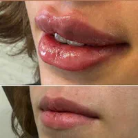 جشنواره تزریق تخصصی ژل و بوتاکس کلینیک نورا|خدمات آرایشگری و زیبایی|کرمانشاه, |دیوار