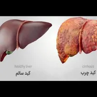 درمان کبد چرب توسط پزشک متخصص