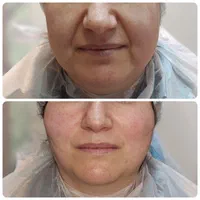 لیفت صورت با نخ جوانسازی پوست تزریق ژل بوتاکس|خدمات آرایشگری و زیبایی|تهران, ونک|دیوار