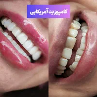 کامپوزیت،لمینیت،روکش،بلیچینگ در دندانپزشکی کیانمهر|خدمات آرایشگری و زیبایی|کرج, کیانمهر|دیوار