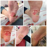 زخم دیابتی و زخم بستردرمنزل،پانسمان سوختگی