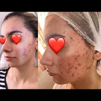 پاکسازی پوست فشیال لیزر پوست فیشیال|خدمات آرایشگری و زیبایی|شیراز, درکی|دیوار