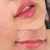 تزریق ژل بوتاکس پی ارپی درکلینیک|خدمات آرایشگری و زیبایی|کرمانشاه, |دیوار