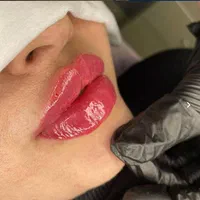 ژل فیلر  زاویه سازی لیفت هایفو بلفارو مزو آنزیم|خدمات آرایشگری و زیبایی|مشهد, هفت تیر (حافظ)|دیوار