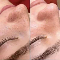 فشیال مزوتراپی مو‌ هیرفیلر پی ار پی prp مزونیدلینگ|خدمات آرایشگری و زیبایی|کرج, مهرویلا جنوبی|دیوار