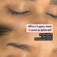 تخفیف ویژه پاک کردن تتو با لیزر