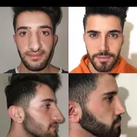 عمل جراحی بینی وترمیم باپیزو/لیفت صورت وپلک|خدمات آرایشگری و زیبایی|کرج, چهارصد دستگاه|دیوار
