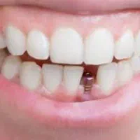 خدمات تخصصی ایمپلنت نقدواقساط۱۸ماه