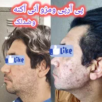 پی آرپی مو وصورت وبوتاکس آف خورده|خدمات آرایشگری و زیبایی|کرمانشاه, |دیوار