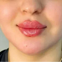 ژل بوتاکس فیلرکیلینیک زیبایی