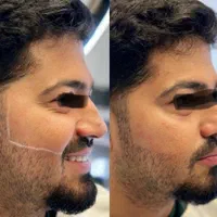 لیزر تخصصی موهای زائد آقایان توسط پزشک