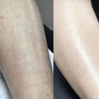 مرکز لیزر موهای زائد کندلا‌ لیزر میکروسوییچ پلکسر|خدمات آرایشگری و زیبایی|اصفهان, برازنده|دیوار