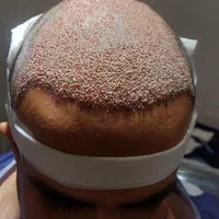 خدمات زیبایی کاشت مو