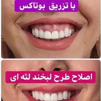 رفع تضمینی تعریق زیر بغل و کف دست|خدمات آرایشگری و زیبایی|تبریز, |دیوار