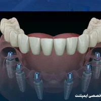 ایمپلنت دندان دندانپزشکی کامپوزیت لمینت کلیه خدمات