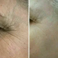 آموزش تخصصی ژل و بوتاکس پی ار پی نخ با مدرک|خدمات آموزشی|تهران, سعادت‌آباد|دیوار