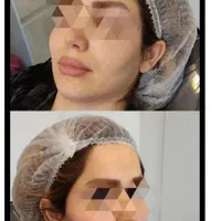 تزریق ژل و بوتاکس تمام ایام حتی روزهای تعطیل|خدمات آرایشگری و زیبایی|فردیس, |دیوار