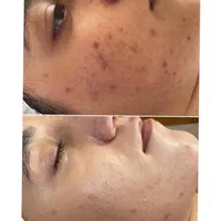 درمان مشکلات پوست مطب/مزوتراپی/فشیال/مزونیدلینگ/ژل|خدمات آرایشگری و زیبایی|مشهد, دانشجو|دیوار