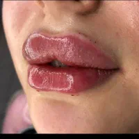 ژل و بوتاکس و لیفت نخ مزوتراپی و آنزیم.فیلربادی|خدمات آرایشگری و زیبایی|کرج, مهرویلا جنوبی|دیوار