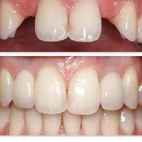 کلینیک تخصصی روکش و روکش ایمپلنت با تضمین کیفیت|خدمات آرایشگری و زیبایی|تبریز, |دیوار