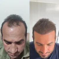 جشنواره کاشت مو|خدمات آرایشگری و زیبایی|زنجان, |دیوار