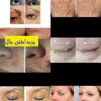 برداشتن انواع خال لک زیگیل تناسلی و...|خدمات آرایشگری و زیبایی|اصفهان, شهرک کوثر|دیوار