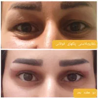 بلفاروپلاستی ورفع افتادگی پلکها(پتوز)توسط چشم پزشک