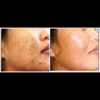 تخصصی پی آر پیprpحرفه ای بوتاکس ژل حجامت70فیلر فصد|خدمات آرایشگری و زیبایی|اصفهان, وحید|دیوار