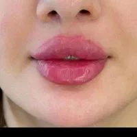 جشنواره تابستانه تزریق ژل وبوتاکس توسط پزشک متخصص