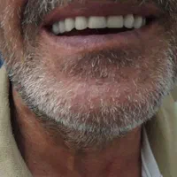 دندان مصنوعی متحرک (تحویل ۳ روزه)|خدمات آرایشگری و زیبایی|کرمانشاه, |دیوار