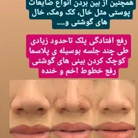 الکترولیز.پیرسینگ.پلاسما.خالبرداری|خدمات آرایشگری و زیبایی|سنندج, |دیوار