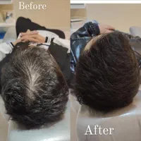 مزوتراپی پوست و مو،ژل و بوتاکس و تزریق چربی