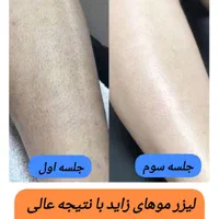 کیوسوئیچ، لیزر موهای زائد، هایفو، جوانسازی|خدمات آرایشگری و زیبایی|آبادان, |دیوار