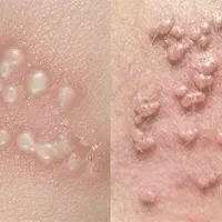 برداشتن زگیل تناسلی دست پا میخچه وخال جای بخیه