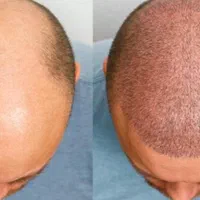 کاشت مو در بهترین کلینیک بندرعباس
