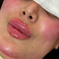 آموزش و انجام خدمات زیبایی ژل، بوتاکس ، آنزیم.مزو|خدمات آرایشگری و زیبایی|بروجرد, |دیوار