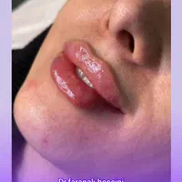 تخفیف تزریق ژل بوتاکس هایفولیزر فیلربادی لیفت بانخ|خدمات آرایشگری و زیبایی|تهران, ستارخان|دیوار