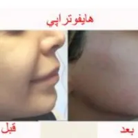 هایفوتراپی لیفت صورت رفع غبغب|خدمات آرایشگری و زیبایی|تهران, میرداماد|دیوار