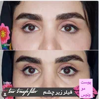جشنواره50%تزریق ژل390مادلینگ هایفو لیزر مو ‌زائد|خدمات آرایشگری و زیبایی|تهران, ستارخان|دیوار