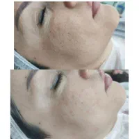 فیشال و پاکسازی پوست|خدمات آرایشگری و زیبایی|شیراز, عادل آباد|دیوار