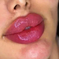 تخفیف ویژه فیلرلب،ژل،انزیم لب،بوتاکس،پی ار پی