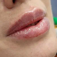 بوتاکس،فیلر،لیزر خانم و آقا،مزو،فیشال|خدمات آرایشگری و زیبایی|ری, دیلمان|دیوار