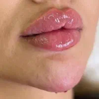 تزریق ژل فیلر بوتاکس مزوژل|خدمات آرایشگری و زیبایی|مشهد, طبرسی شمالی|دیوار