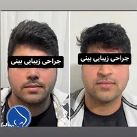جراحی زیبایی بینی فقط با 22 میلیون|خدمات آرایشگری و زیبایی|قائم‌شهر, |دیوار